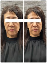 長寿鍼灸院 長寿整骨院/美容鍼50本の効果★ハリ・ツヤ