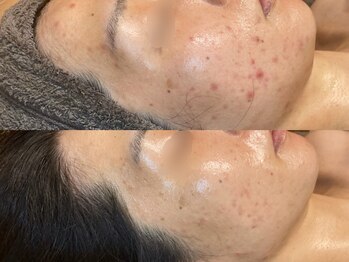 ビジュープラス 広島店(Bijou+)/【20代/ニキビケア】