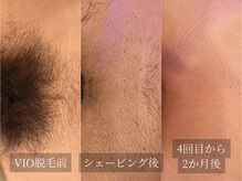 アルム(Arum)/メンズVIO脱毛