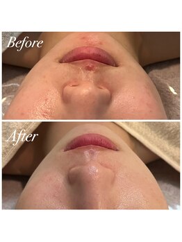 プララン 京都桂店(Plaran)/乳酸菌ピール×剥離ピーリング