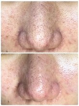 ミント/洗顔後もすぐに臭う悩み