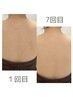 【背中の産毛除去/夏前の準備に◎】背中脱毛（背中上部まで）　初回¥4,800