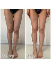 セルビューティー(Cell Beauty)/40代、筋膜リリース下半身20回