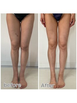 セルビューティー(Cell Beauty)/40代、筋膜リリース下半身20回