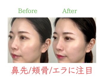 ラプリ 福岡博多店(Raplit)/隆鼻+輪郭・小顔矯正 美鼻/小顔