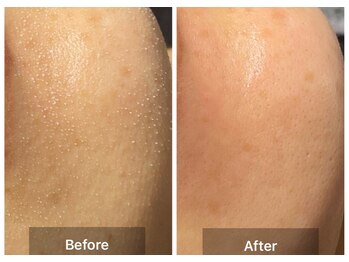 ステッラ(STELLA☆)/毛穴洗浄　Before/After