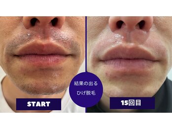 フェイシャル専門サロン サロン ド ウイッシュ/メンズひげ脱毛