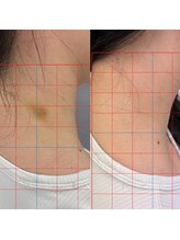 ハーモニーフィットネス 赤坂(Harmony Fitness)/アザ改善