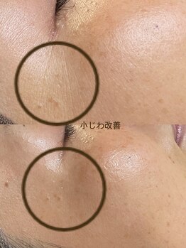 ニコリ(Nicori)/シェービング+光フェイシャル