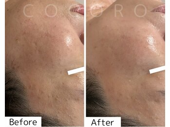 ココロ(COCORO)/最短で肌質改善を目指すなら