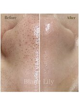 ブランリリー(Blanc Lily)/毛穴にも◎