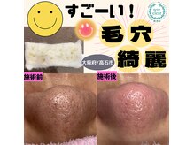 ビーナス(Venus)の雰囲気（1度でも効果実感◎毛穴の詰まり黒ずみに！取れた角栓も見れる！）