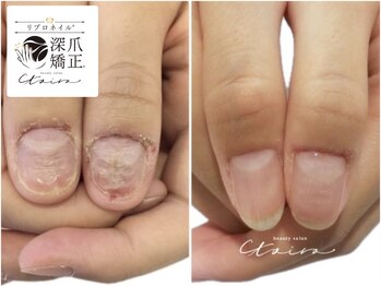 トイロ(toiro)の写真/《私の爪でも大丈夫？》そんな不安を抱えている方へ。初めての深爪矯正、まずは爪のお悩みをご相談ください