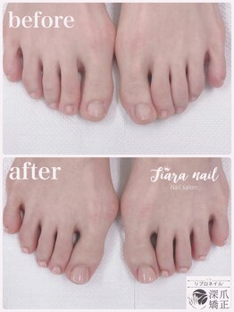 ティアラネイル 宇都宮/リプロネイル深爪矯正コース