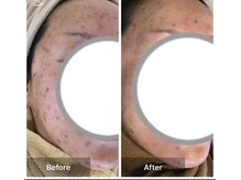 モカ 天王寺店(MOKA)/ホホニキビケアハーブピーリング