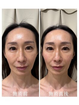 メディカルエース(MedicalAce)/ブライティングリフト