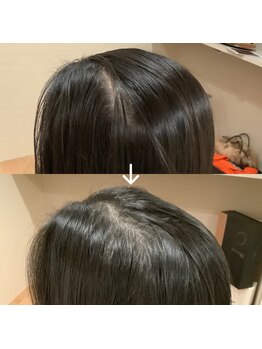 トトノエル(TOTONOEL)/真空ヘッドスパ