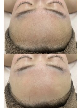 カルディエ(Cardie)/おでこ脱毛　ビフォーアフター