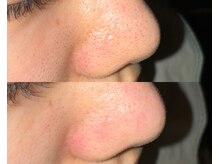 ル シーニュ/毛穴エクストラクション