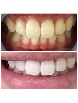 夏目ホワイトニングアンドネイル(夏目WHITENING＆NAIL)の写真/結果重視◎輝くような白い歯に！短時間、リーズナブルにホワイトニング体験しませんか？