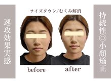 マインドボディ コモレビ(MIND BODY Komorebi)の雰囲気（【小顔矯正】一度でフェイスラインがスッキリ！整形級の小顔♪）