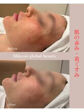 ミニョ コリアンビューティー(Minyoo korean beauty)/症例写真/肌の赤み・黄くすみ