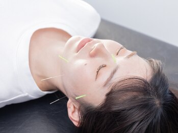 ナチュラルエイジングプラス(naturalaging+)の写真/《目鼻立ちまで印象が変わる小顔リフトアップ》美容鍼×小顔整体で歪みを正し究極リフト！即効性抜群◎