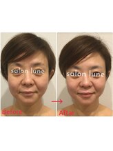 サロン リュンヌ(salon lune)/ハーブピーリング