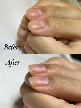 マリーロール 梅田店(Marie Laure)/自爪育成/深爪矯正/ネイルケア