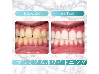 ロイヤル(ROYAL)/【ホワイトニング】before/after