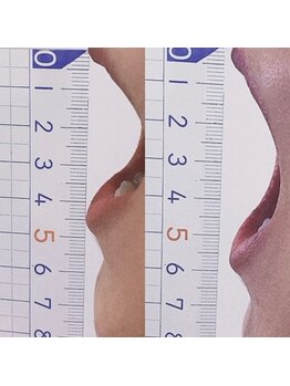 ランドル(rendre)/３０代女性　開口すると顎が痛い