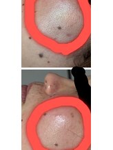 ピュア(Pure)/ハイドラスノーピール