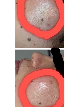 ピュア(Pure)/ハイドラスノーピール