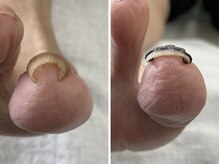 西宮巻き爪矯正センター
