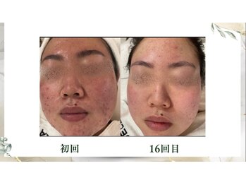 サロンドエクラ 南堀江(salon de eclat)/韓国最先端美容