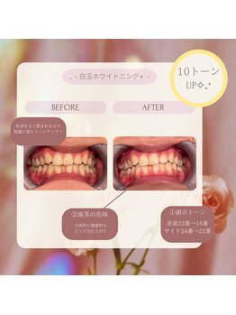 プラスビーセルフ(+b self)/ホワイトニングビフォーアフター