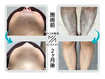 メンズアメリ/高知/メンズ脱毛/ヒゲ/全身/VIO