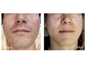 アットイカウ 下北沢(at ikaw)/全顔スッキリ脱毛 Before/After