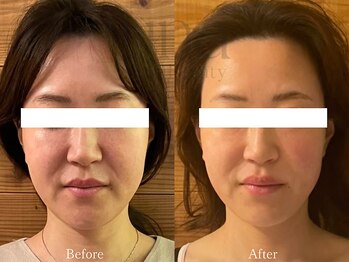 ウナ 西中島店(UNA)/小顔お肉取りケア バキュームRF