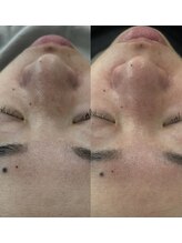 ファーファラ(Farfalla)/毛穴洗浄×水光ピーリング