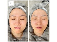 サロン ド パーフェクション(Salon de Perfection)/小顔リフト