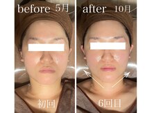 イーストモア(EAST MOIS)/w光フェイシャル6回継続した結果