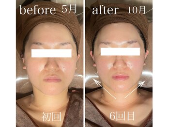 イーストモア(EAST MOIS)/w光フェイシャル6回継続した結果