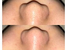 ル シーニュ/毛穴エクストラクション