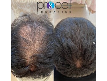 オウジエステサロン(OJIエステサロン)の写真/男性の頭皮悩みにアプローチ!抜け毛・M字・ボリューム悩みにプロセルセラピーズ♪