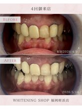 ホワイトニングショップ 福岡姪浜店/美白ホワイトニングbefore after