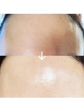 トトノエル(TOTONOEL)/幹細胞培養上清液導入（顔）