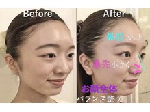 ラプリナーゼ 吉祥寺店(Raplit Nase)/隆鼻＋輪郭小顔矯正40分10回