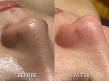 クロシェ/気になる黒ずみ毛穴から解放