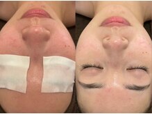 オヤム(oyam)/《ハーブピーリング》